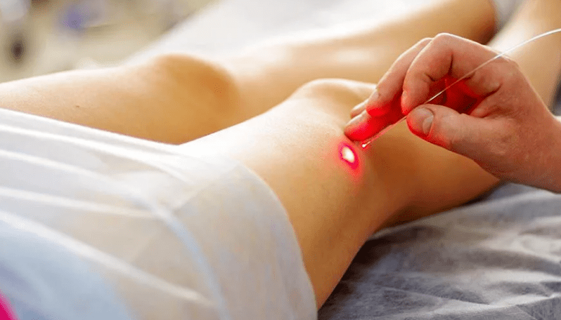 Coagulation laser des varices