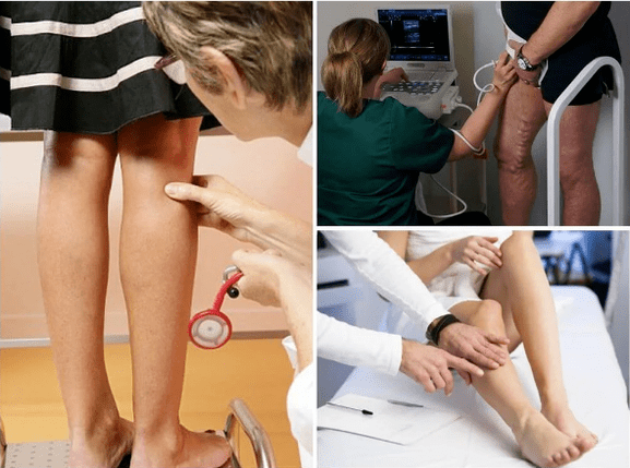 Varices sur les jambes