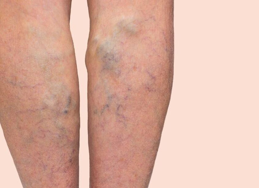 Quelles varices