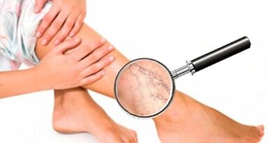Les causes des varices