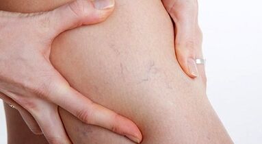 Signes et symptômes de varices