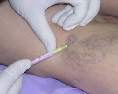 injections pour les varices