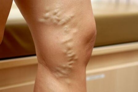 médicaments pour les varices