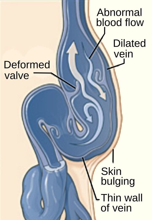 Varices