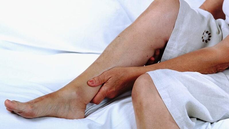 Femme souffrant de varices sur les jambes